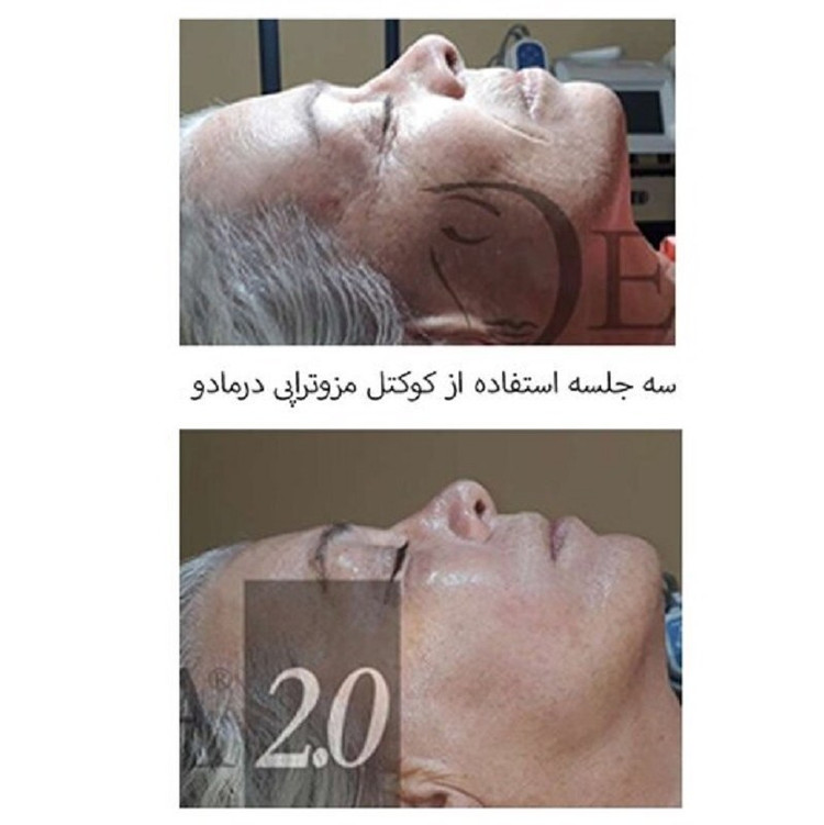 کوکتل مزوتراپی ریکاوری و بازیابی 360 درجه پوست برند درمادو ساخت ایتالیا تضمینی