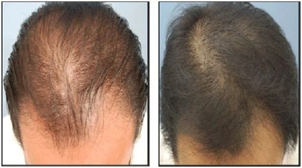 کوکتل مزولایک هیرمن